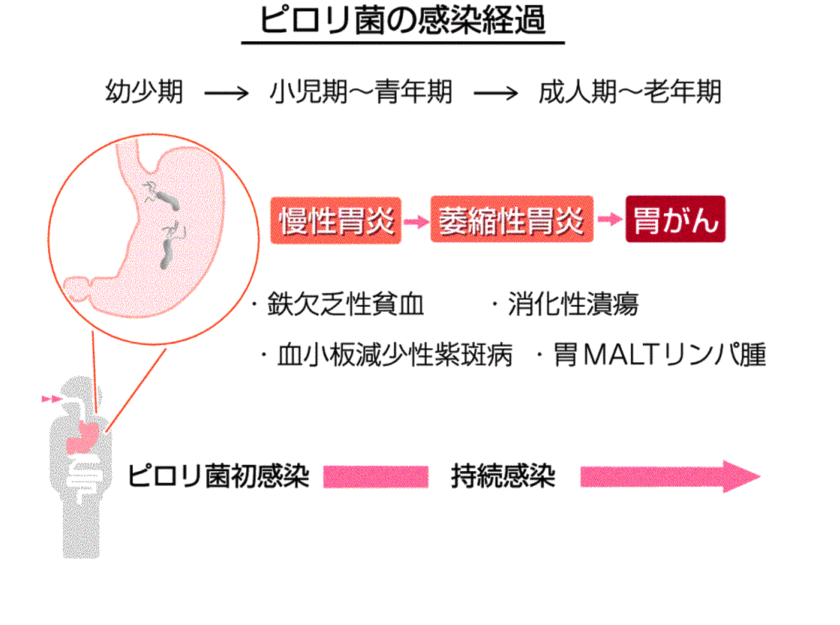 性 貧血 欠乏 鉄